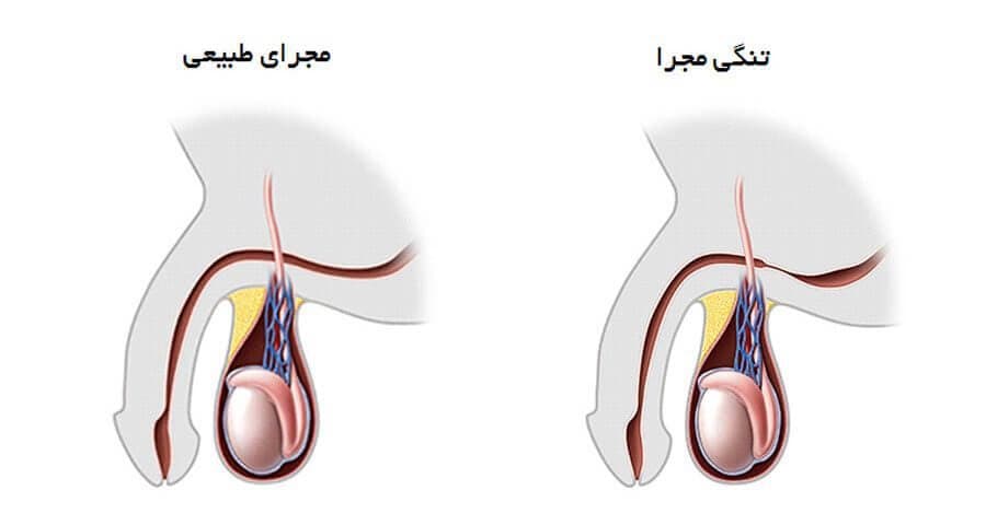 تنگی مجرا