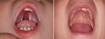 شکاف کام ( جزوه آموزشی )