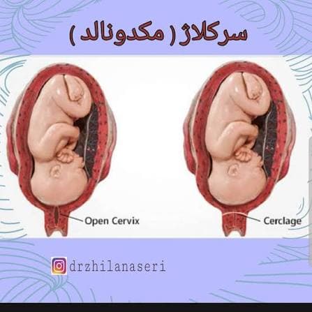 عمل بستن دهانه رحم (سرکلاژ) - جزوه آموزشی