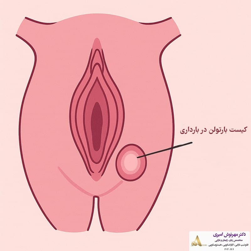 غده در دهانه واژن (کیست بارتولن) - جزوه آموزشی