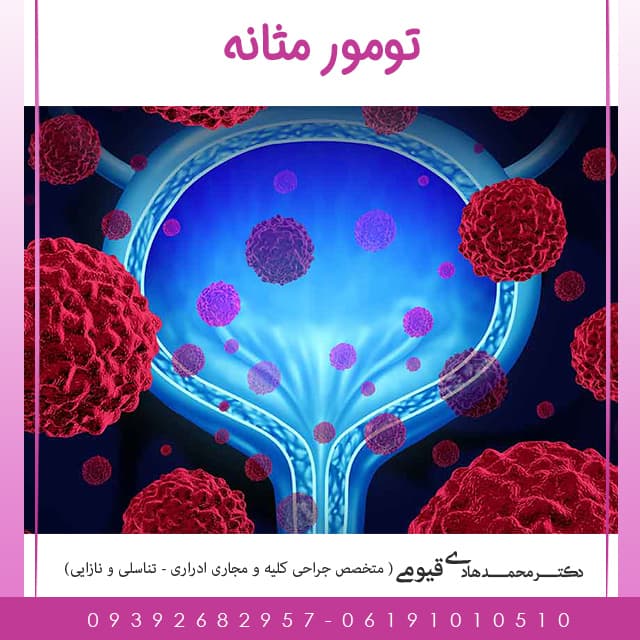 تومور مثانه ( جزوه آموزشی )