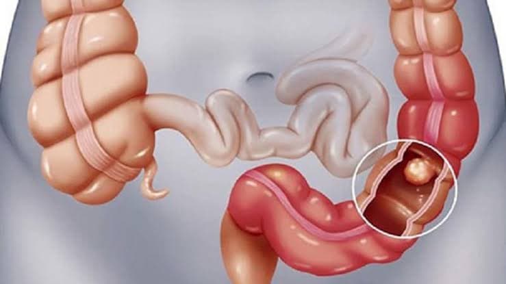 سرطان روده (کولون و رکتوم )